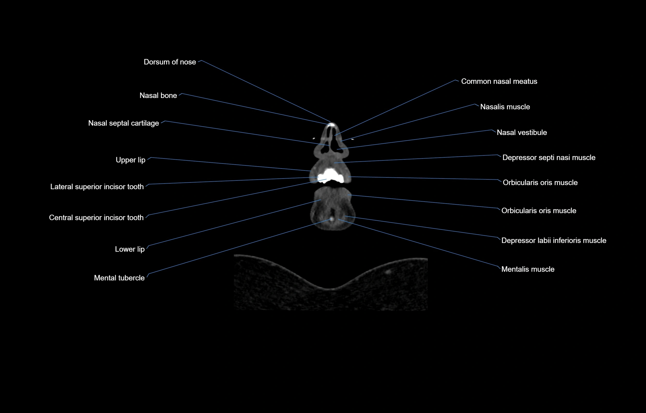 CT Neck coronal  cross sectional anatomy labelled 3D  radiology  image-00006.webp